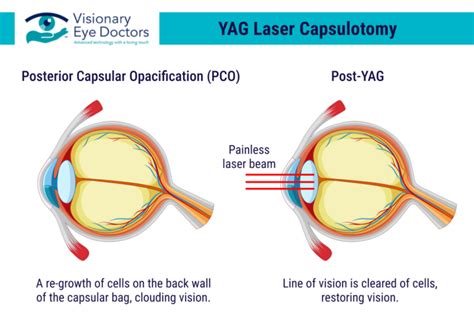 yag laser huddersfield|YAG laser capsulotomy Specialists in Huddersfield .